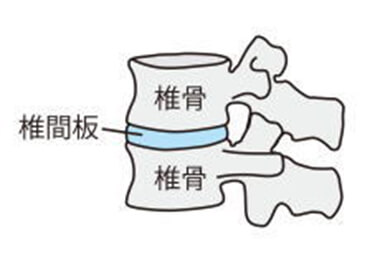 腰の痛み