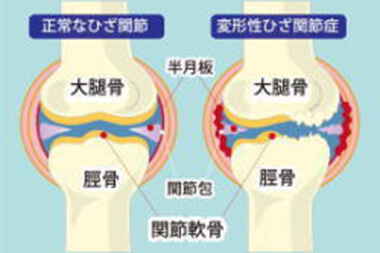 膝の痛み